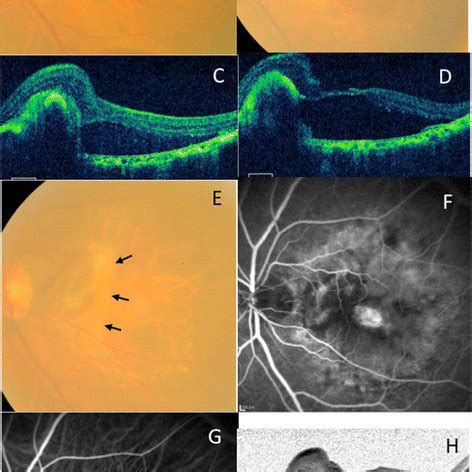 The Progression Findings For Macular Hole Formation A C One Month