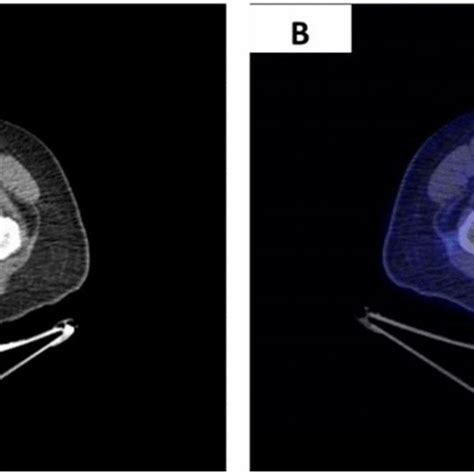 High Power View Of The Tumoral Cells In The Fine Needle Biopsy Taken