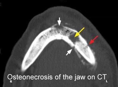 Osteonecrosis of the Jaw