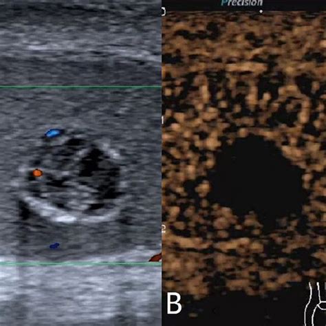 Testicular Epidermoid Cyst A Conventional Ultrasound Showed An Uneven Download Scientific