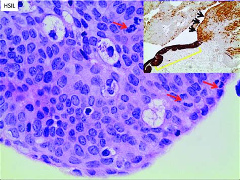 High-grade squamous intraepithelial lesion (HSIL/AIN-2/3) High-grade... | Download Scientific ...