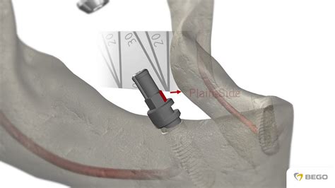 Bego Implant Systems Multiplus Restoration Multiplus Versorgung