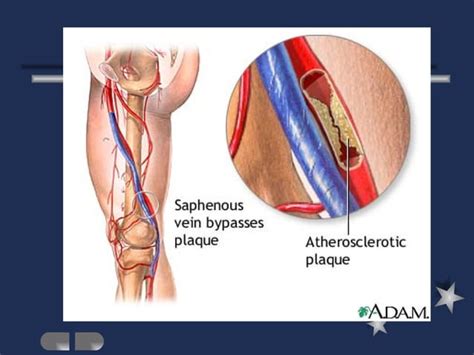 Peripheral Vascular Diseases Ppt