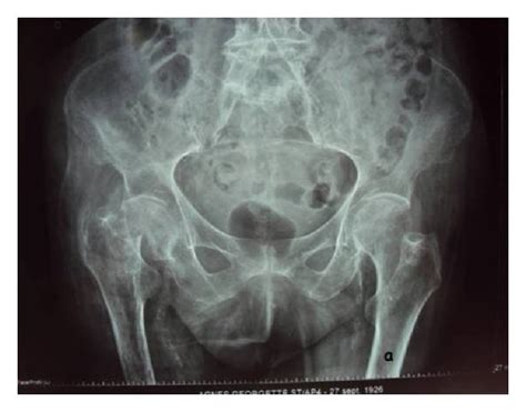 The X Ray Of The Pelvis And The Hip An Anteroposterior X Ray Showing