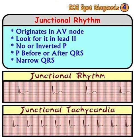 Junctional Rhythm In Cardiology