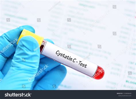 Blood Sample Tube Cystatin C Test Stock Photo 1220808490 | Shutterstock