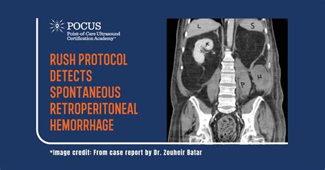 Retroperitoneal Bleed Ultrasound