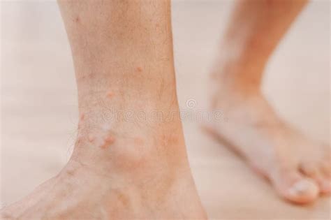 Dermatite Allergica Da Eruzione Cutanea Eczema A Piedi Coscia Con