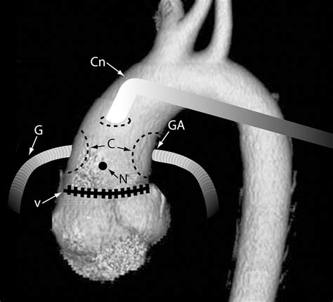 Multidetector Ct Of Thoracic Aortic Aneurysms Radiographics