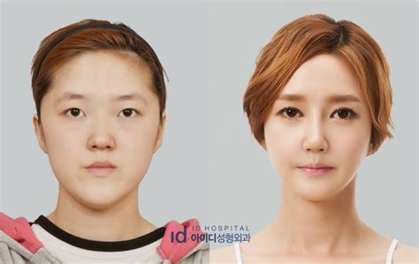 Id Hospital Korea Best Double Eyelid Surgeon In Korea