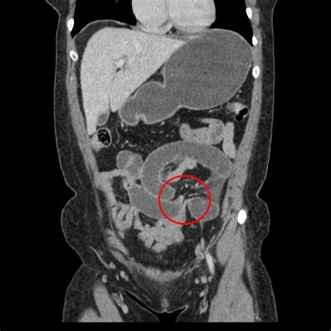 Closed Loop Bowel Obstruction X Ray Online Aria