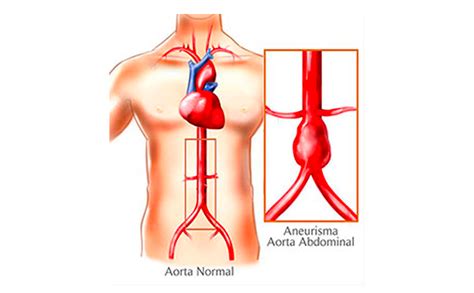 Aneurismas Da Aorta Instituto Vascular SP