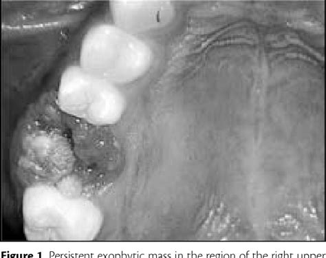 Figure 1 From Recurrent Solid Ameloblastoma Of The Maxillary Sinus A