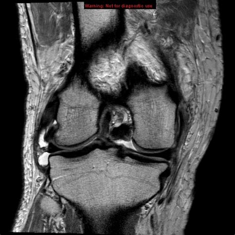 Transient Lateral Patellar Dislocation Image Radiopaedia Org