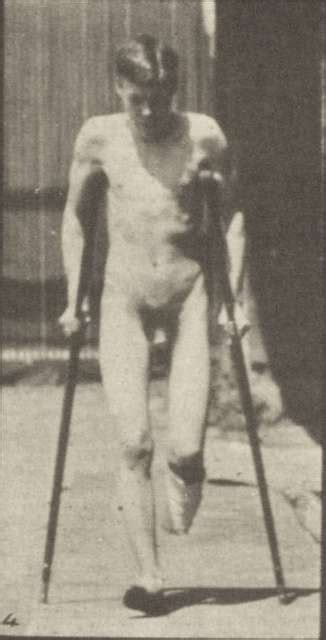 Nude Man With Single Amputation Of Leg Hopping With Crutches Rbm Qp M B Picryl