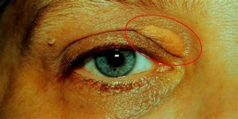 Calcium Deposits On Inner Eyelids Mapasgmaes