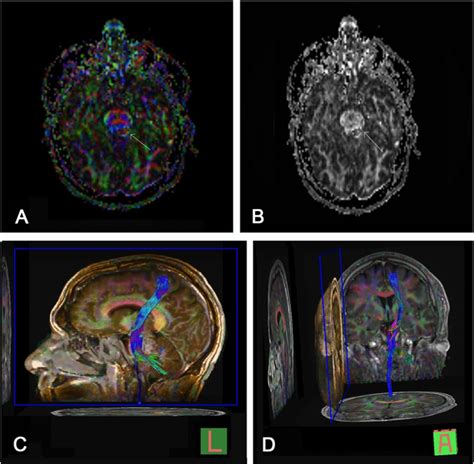 Diffusion Tensor Imaging And Tractography Utilized In The Resection Of