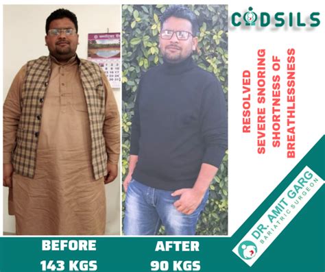 Bariatric Surgery Results Success Stories Dr Amit Garg