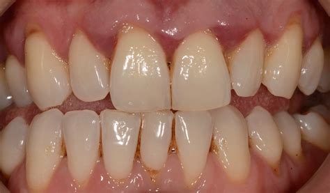 Receding Gums Stages