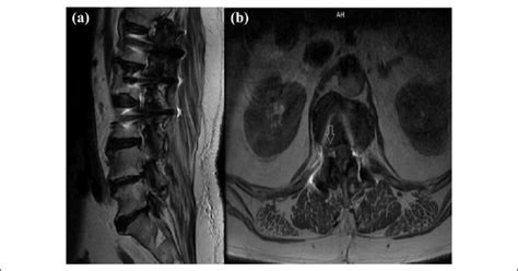 A Sagittal And B Axial Preoperative T2 Weighted Mri Of A Patient In