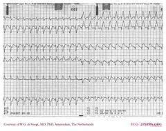 De Voogt ECG Archive Myocardial Infarction Anterior ECGpedia