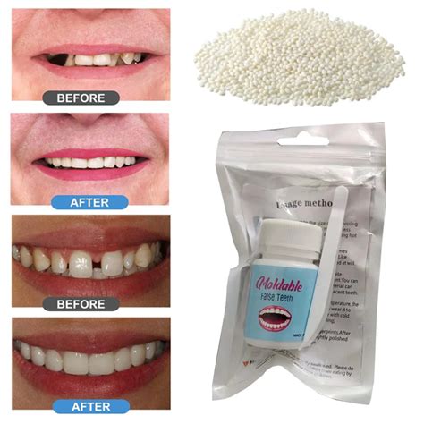 Resina Dental Shapeable Dentes Cola Part Culas De Material De