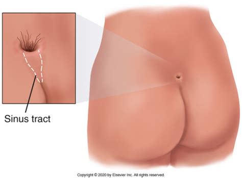 Chapter Anus Rectum And Prostate Flashcards Quizlet