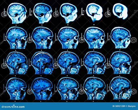 Mri Brain Scan Stock Image Image Of Anatomy Brain Imagery