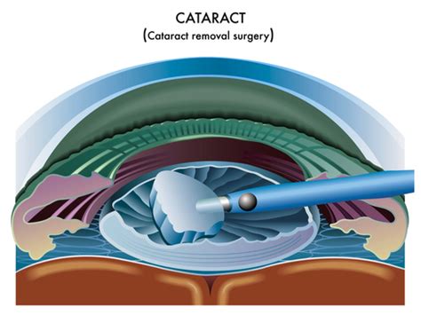 Cataract Surgery Diagram Mr Shahram Kashani