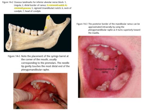 Inferior Alveolar Nerve Block Landmarks