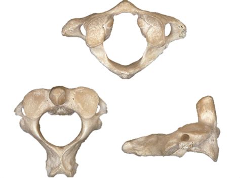 3. Atlas and Axis Vertebrae Diagram | Quizlet