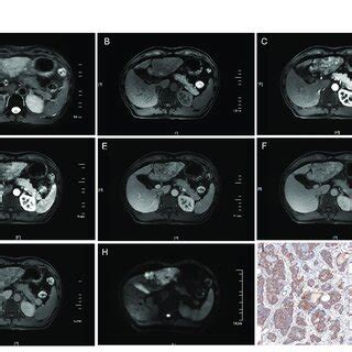 Mri Of A Vegfr Positive Hcc Patient With Li Rads Patient Summary A