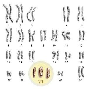 Genes Del Cromosoma Downciclopedia Org