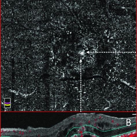 Optical Coherence Tomography Angiography OCTA And Structural Optical