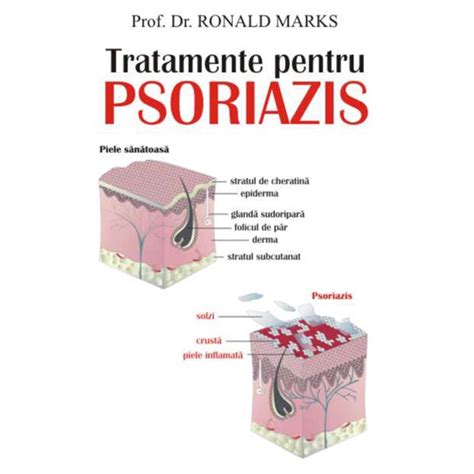 Tratamente Pentru Psoriazis Prof Dr Ronald Marks Editura Antet