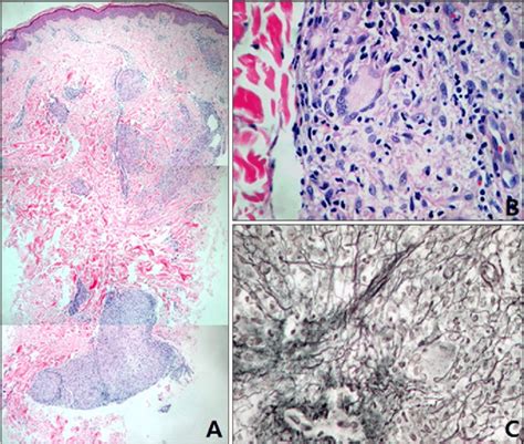 A Histologic Examination Shows A Well Circumscribed Noncaseating