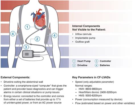 Left Ventricular Assist Devices A Primer For The General Cardiologist