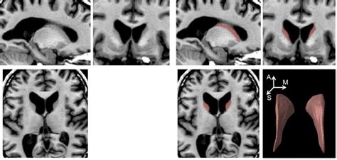 Caudate Nucleus On Anatomical Mri An Expert Manually Delineated Download Scientific Diagram