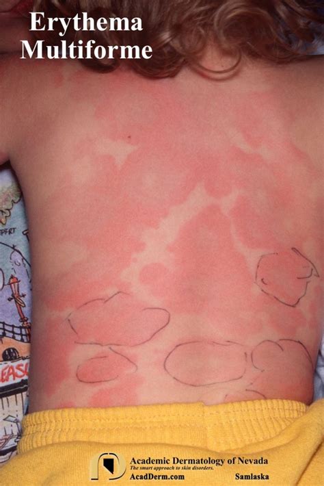 Erythema Multiforme Erythema Exudativum Multiforme Academic Dermatology Of Nevada