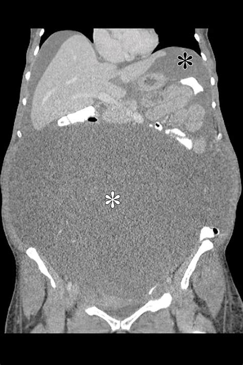 Mucinous Neoplasms Of The Ovary Radiologic Pathologic Correlation