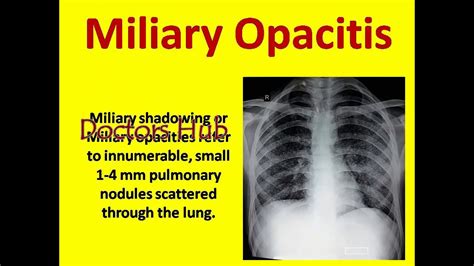 Chest Xray With Miliary Shadowing Youtube