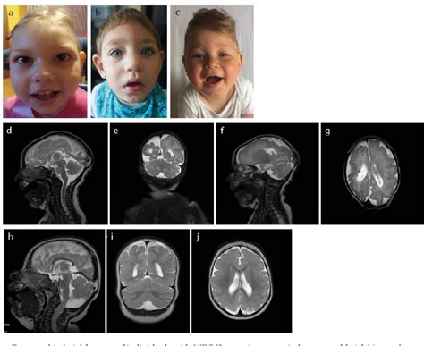 Figure 1 From Further Delineation Of Phenotype And Genotype Of Primary