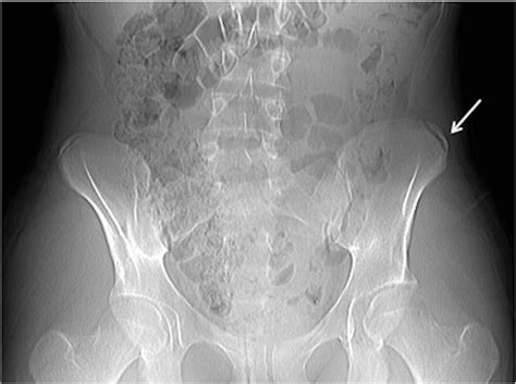 Ilium Pain