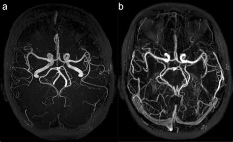 MR angiography types. a Time-of-flight MR angiography (TOF-MRA) and b ...