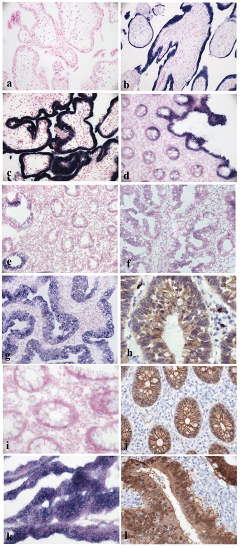 Rna In Situ Hybridization And Ihc Analysis Of Colorectal Cancer Cases