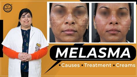 How To Treat Melasma Treat Dark Spots And Patches On The Skin Causes And Best Creams Of Melasma