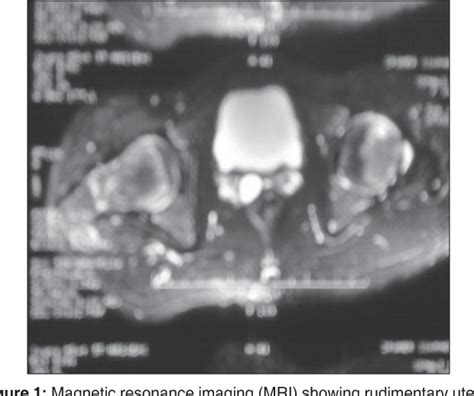 Figure 1 From A Rare Case Report Of 46xy Mixed Gonadal Dysgenesis