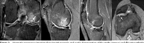 Figure 2 From Medium Term Outcome Of Mosaicplasty For Grade Iii Iv Cartilage Defects Of The Knee