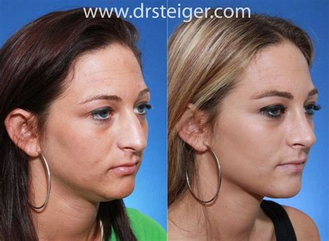 Rhinoplasty Before And After Photos Rhinoplasty Before And After