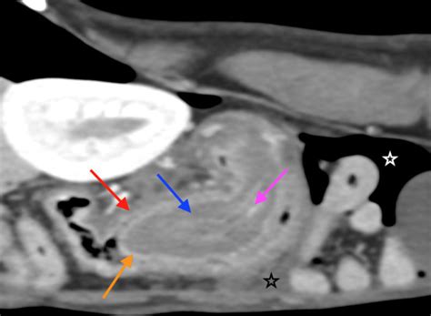 Right Parasagittal Contrast Enhanced Ct Image Of The Abdomen Of Case 1